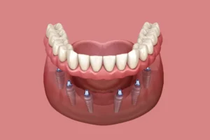 All On 6 Dental Implants in Dubai