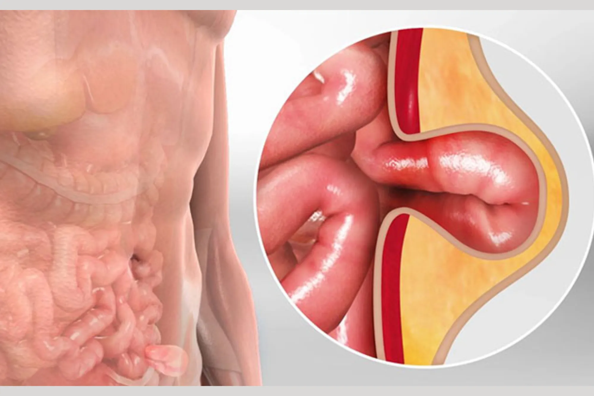 Understanding Hernias in Dubai